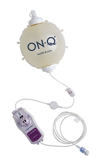 ON-Q-CB: Variable flow pumps and/or bolus