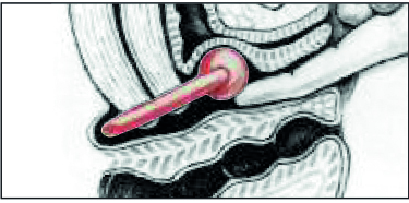 Milex Prolapsring med knopp
