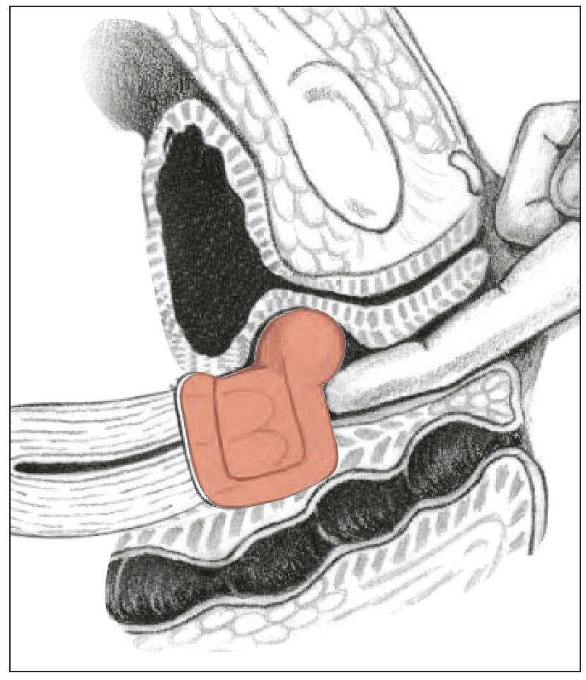 Milex Gehrung med knopp