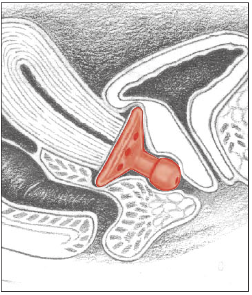 Milex Gellhorn, lång stam