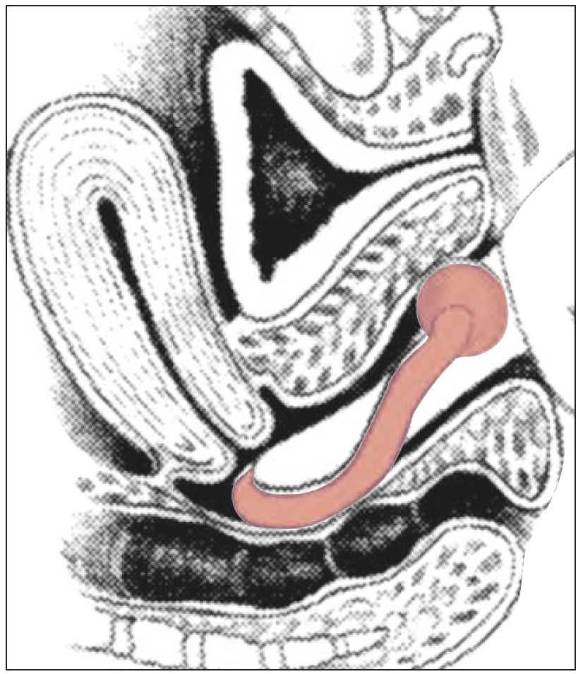 Milex Hodge med membran och knopp