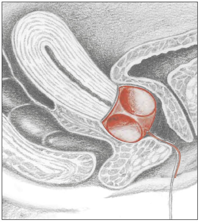 Milex Kub med dränagehål