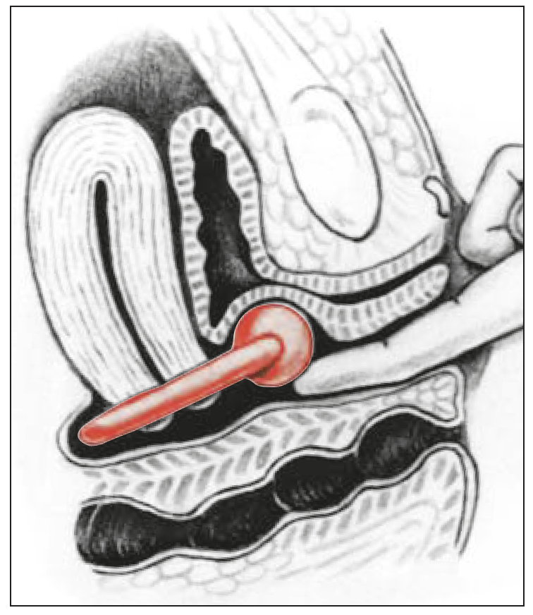 Milex Prolapsring med knopp och membran, vikbar