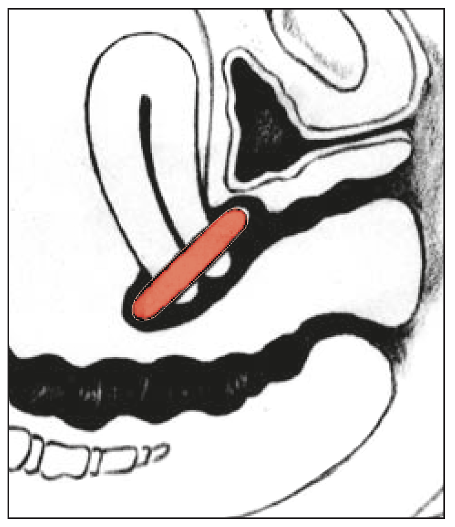 Milex Prolapsring med membran, vikbar